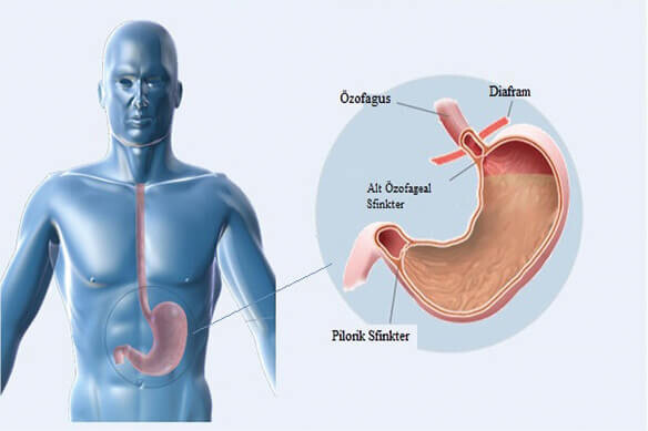 GASTROÖZEFAGEAL REFLÜ HASTALIĞI