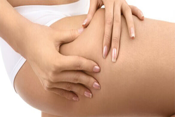 Selülit Sorunu için Çözüm Arayışı