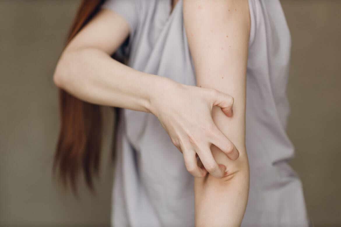 Vücutta Kaşıntı ve Kabarcıklar Neden Olur, Nasıl Geçer?