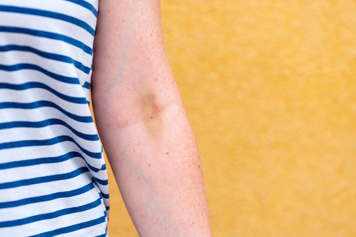 Kollarda Sivilce Lekeleri: Nasıl Geçer ve Tedavisi Nasıldır?
