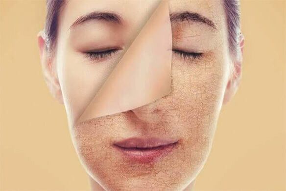 Kuru Ciltler İçin Çözüm Önerileri