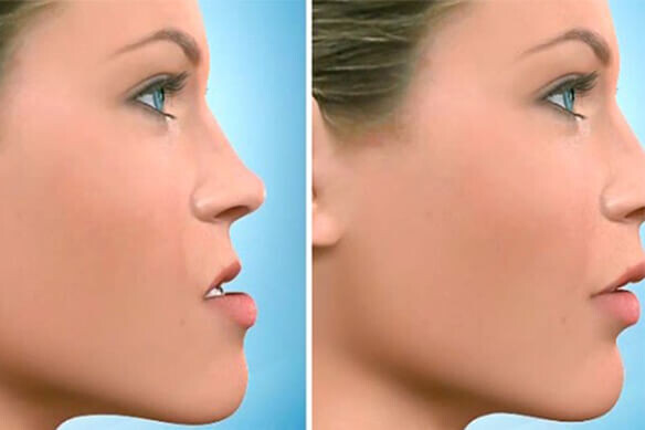 Ortognatik Cerrahi Uygulamalar