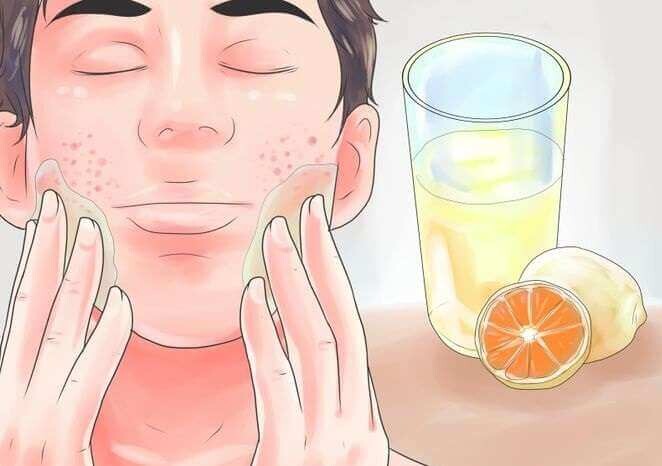 Siyah nokta ve Sivilceler :